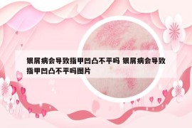銀屑病會(huì)導(dǎo)致指甲凹凸不平嗎 銀屑病會(huì)導(dǎo)致指甲凹凸不平嗎圖片