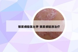 銀屑病輸氯化鉀 銀屑病輸液治療