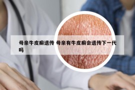 母親牛皮癬遺傳 母親有牛皮癬會(huì)遺傳下一代嗎