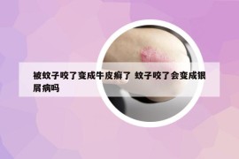 被蚊子咬了變成牛皮癬了 蚊子咬了會變成銀屑病嗎