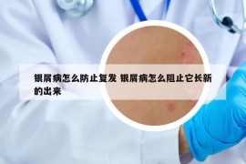 銀屑病怎么防止復(fù)發(fā) 銀屑病怎么阻止它長新的出來