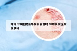 蚌埠長城醫(yī)院治牛皮癬靠譜嗎 蚌埠長城醫(yī)院皮膚科