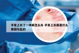 手背上長(zhǎng)了一塊癬怎么辦 手背上長(zhǎng)癬是什么原因引起的