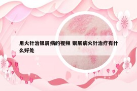用火針治銀屑病的視頻 銀屑病火針治療有什么好處