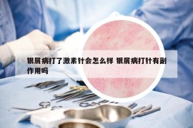 銀屑病打了激素針會(huì)怎么樣 銀屑病打針有副作用嗎
