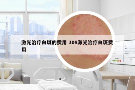 激光治療白斑的費(fèi)用 308激光治療白斑費(fèi)用
