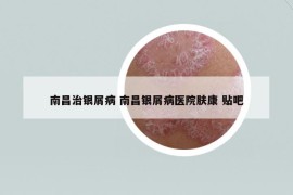 南昌治銀屑病 南昌銀屑病醫(yī)院膚康 貼吧