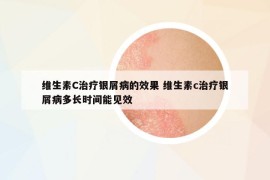 維生素C治療銀屑病的效果 維生素c治療銀屑病多長(zhǎng)時(shí)間能見(jiàn)效