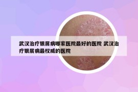 武漢治療銀屑病哪家醫(yī)院最好的醫(yī)院 武漢治療銀屑病最權(quán)威的醫(yī)院