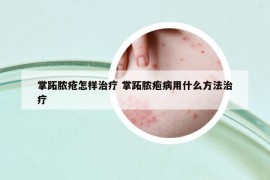 掌跖膿瘡怎樣治療 掌跖膿皰病用什么方法治療