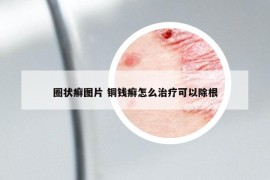 圈狀癬圖片 銅錢癬怎么治療可以除根