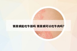 銀屑病能吃牛筋嗎 銀屑病可以吃牛肉嗎?