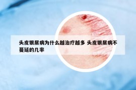 頭皮銀屑病為什么越治療越多 頭皮銀屑病不蔓延的幾率