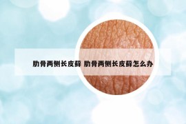肋骨兩側(cè)長(zhǎng)皮蘚 肋骨兩側(cè)長(zhǎng)皮蘚怎么辦