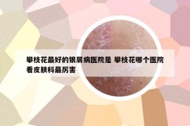 攀枝花最好的銀屑病醫(yī)院是 攀枝花哪個醫(yī)院看皮膚科最厲害