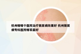杭州哪哪個醫(yī)院治療銀屑病效果好 杭州銀屑病專科醫(yī)院哪家最好
