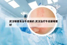武漢哪里有治牛皮癬的 武漢治療牛皮廨哪里好