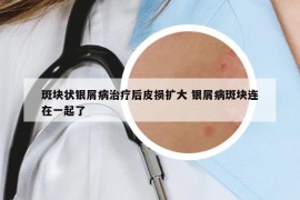 斑塊狀銀屑病治療后皮損擴(kuò)大 銀屑病斑塊連在一起了