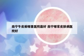 南寧牛皮癬哪里醫(yī)院最好 南寧哪家皮膚病醫(yī)院好