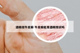 酒精燒牛皮癬 牛皮癬能用酒精擦拭嗎
