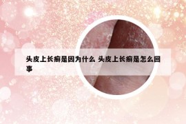 頭皮上長(zhǎng)癬是因?yàn)槭裁?頭皮上長(zhǎng)癬是怎么回事