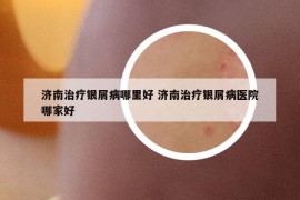 濟(jì)南治療銀屑病哪里好 濟(jì)南治療銀屑病醫(yī)院哪家好