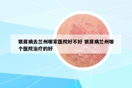 銀屑病去蘭州哪家醫(yī)院好不好 銀屑病蘭州哪個醫(yī)院治療的好