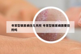 尋常型銀屑病住幾天院 尋常型銀屑病需要住院嗎