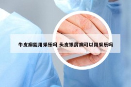 牛皮癬能用采樂嗎 頭皮銀屑病可以用采樂嗎