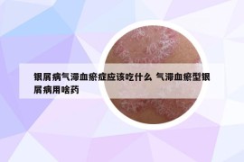 銀屑病氣滯血瘀癥應(yīng)該吃什么 氣滯血瘀型銀屑病用啥藥