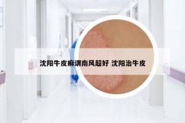 沈陽(yáng)牛皮癬謂南風(fēng)超好 沈陽(yáng)治牛皮