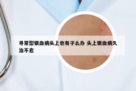 尋常型銀血病頭上也有子么辦 頭上銀血病久治不愈