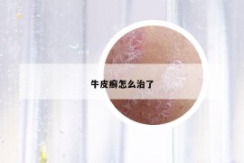 牛皮癬怎么治了