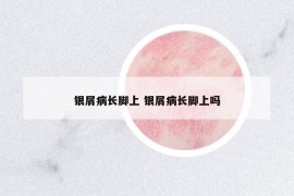 銀屑病長(zhǎng)腳上 銀屑病長(zhǎng)腳上嗎