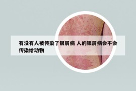 有沒(méi)有人被傳染了銀屑病 人的銀屑病會(huì)不會(huì)傳染給動(dòng)物
