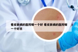 看皮膚病的醫(yī)院哪一個(gè)好 看皮膚病的醫(yī)院哪一個(gè)好點(diǎn)