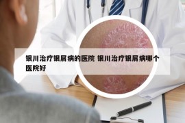 銀川治療銀屑病的醫(yī)院 銀川治療銀屑病哪個(gè)醫(yī)院好