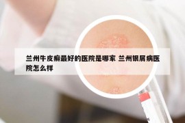 蘭州牛皮癬最好的醫(yī)院是哪家 蘭州銀屑病醫(yī)院怎么樣