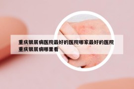 重慶銀屑病醫(yī)院最好的醫(yī)院哪家最好的醫(yī)院 重慶銀屑病哪里看