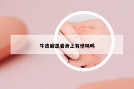 牛皮癬患者身上有怪味嗎