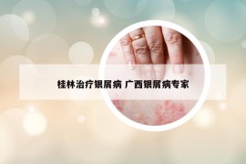 桂林治療銀屑病 廣西銀屑病專家