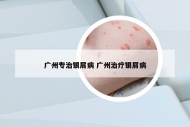 廣州專治銀屑病 廣州治療銀屑病