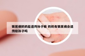 銀屑病奶奶能遺傳孫子嘛 奶奶有銀屑病會(huì)遺傳給孫子嗎