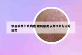 銀屑病關(guān)節(jié)炎病案 銀屑病關(guān)節(jié)炎診斷與治療指南