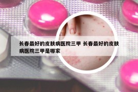 長春最好的皮膚病醫(yī)院三甲 長春最好的皮膚病醫(yī)院三甲是哪家