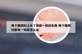 兩個(gè)胳膊肘上長了像癬一樣的東西 兩個(gè)胳膊肘都有一塊癬怎么治