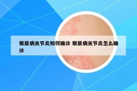 銀屑病關(guān)節(jié)炎如何確診 銀屑病關(guān)節(jié)炎怎么確診