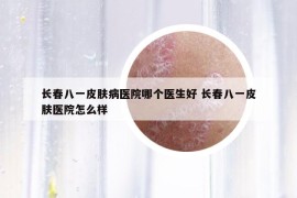 長春八一皮膚病醫(yī)院哪個醫(yī)生好 長春八一皮膚醫(yī)院怎么樣