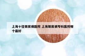 上海十佳銀屑病醫(yī)院 上海銀屑病?？漆t(yī)院哪個(gè)最好
