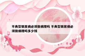 不典型銀屑病必須做病理嗎 不典型銀屑病必須做病理嗎多少錢